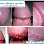 ?‍⚕️ Những Cách Điều Trị Chuỗi Hạt Ngọc Hiệu Quả Hiện Nay