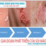 ?‍⚕️ Ưu Điểm Phương Pháp Ala Pdt Trong Điều Trị Sùi Mào Gà