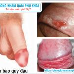 ?‍⚕️ Chi Phí Khám Và Điều Trị Bệnh Viêm Bao Quy Đầu Hiện Nay