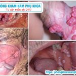 Đắp Lá Đinh Lăng Chữa Sùi Mào Gà Được Không