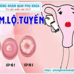 ?‍⚕️ Điều Trị Viêm Lộ Tuyến Tử Cung Cấp Độ 2 Có Khó Không