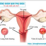 ?‍⚕️ Viêm Lộ Tuyến Cổ Tử Cung Độ 1 Điều Trị Như Thế Nào ?