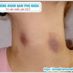 ❤ Cách Làm Mờ Dấu Hickey Nhanh Nhất