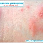 ?‍⚕️ Bộ Phận Sinh Dục Nổi Ban Có Phải Là Bệnh Xã Hội Không