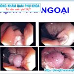 ⚕️ Dấu Hiệu Triệu Chứng Bệnh Trĩ Ngoại Như Thế Nào?