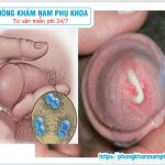 ⚕️ Đầu Dương Vật Chảy Mủ Trắng Đục Là Bệnh Gì?