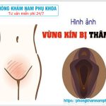 ?‍⚕️ Chi Phí Điều Trị Vùng Kín Thâm Đen Hiện Nay Khoản Bao Nhiêu