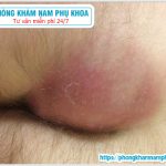 ⚕️ Hậu Môn Bị Sưng Phồng Có Nguy Hiểm Không?