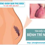 ⚕️ Nguyên Nhân Bệnh Trĩ Ngoại