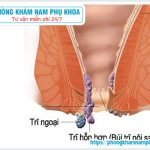 ⚕️ Nguyên Nhân Của Bệnh Trĩ Hỗn Hợp