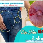 ⚕️ Cách Nhận Biết Bệnh Trĩ Sau Sinh