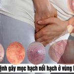 Âm Đạo Nổi Hạt, Nổi Cục Là Bệnh Gì?