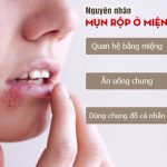 Nguyên Nhân Gây Mụn Rộp Môi Và Cách Chữa Trị