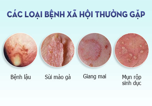 Dấu hiệu những bệnh xã hội thường gặp