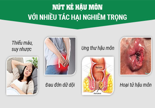 Chi Phí Điều Trị Nứt Kẽ Hậu Môn